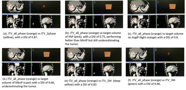 Is an all-phase ITV (internal target volume) a gold standard in the target definition of hepatocellular carcinoma?